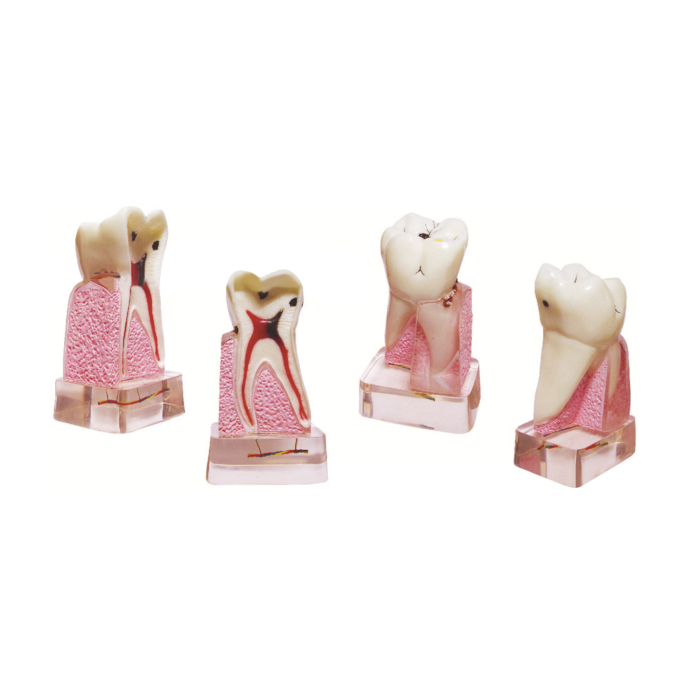 Dental Pathological Model, 4x  - Medical Lab Supplies review and price